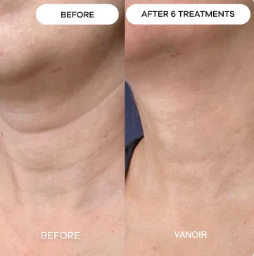 ChronoStamp - Unlock Your Skin's Full Potential - 50% OFF - Image 4