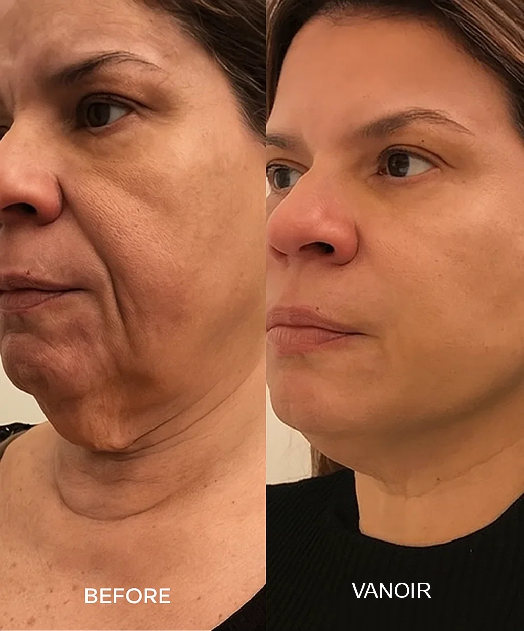 ChronoStamp - Unlock Your Skin's Full Potential - 50% OFF - Image 5