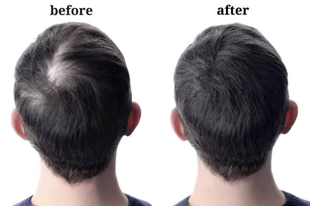 Folli-Gen - Reawaken Your Hair's Fullness - 50% OFF - Image 3