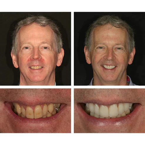 1 + 1 FREE - Ivory™ Teeth Whitening Essence - Image 10
