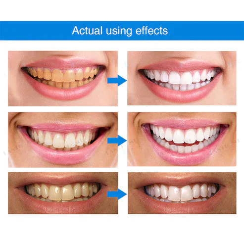 1 + 1 FREE - Ivory™ Teeth Whitening Essence - Image 7