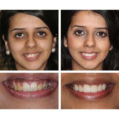 1 + 1 FREE - Ivory™ Teeth Whitening Essence - Image 8