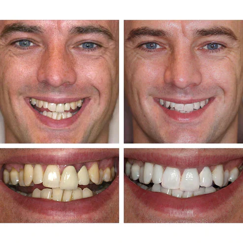 1 + 1 FREE - Ivory™ Teeth Whitening Essence - Image 9