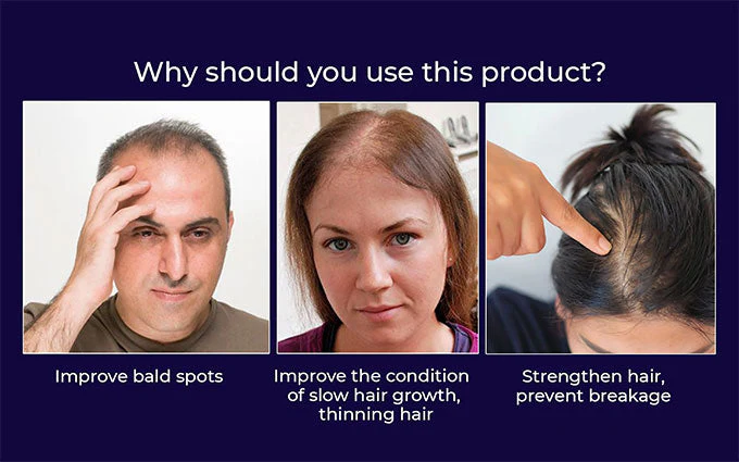 Lovilds Natural Hair Regrowth Spray - Clinically-Inspired Scalp Treatment - 1+1 FREE - Image 8