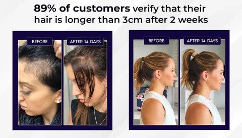 Lovilds Natural Hair Regrowth Spray - Clinically-Inspired Scalp Treatment - 1+1 FREE - Image 9