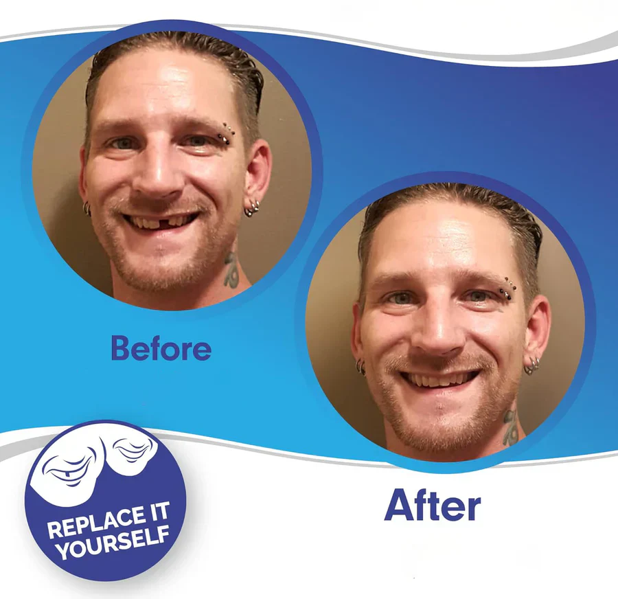 LuminaSmile Instant Confidence Veneers - 50% OFF - Image 3