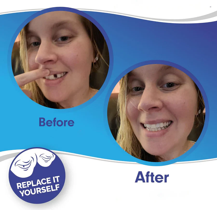 LuminaSmile Instant Confidence Veneers - 50% OFF - Image 4