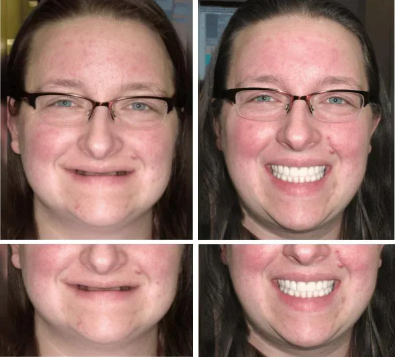 NaturaFit Dentures - The No-Slip, Custom-Fit Smile + 50% OFF - Image 2