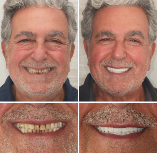 NaturaFit Dentures - The No-Slip, Custom-Fit Smile + 50% OFF - Image 3