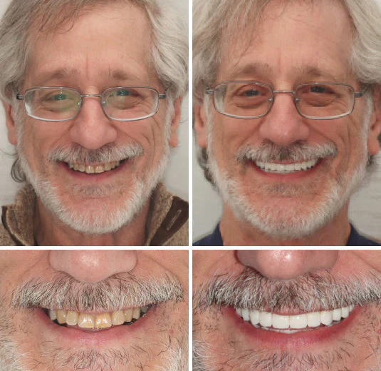 NaturaFit Dentures - The No-Slip, Custom-Fit Smile + 50% OFF - Image 7
