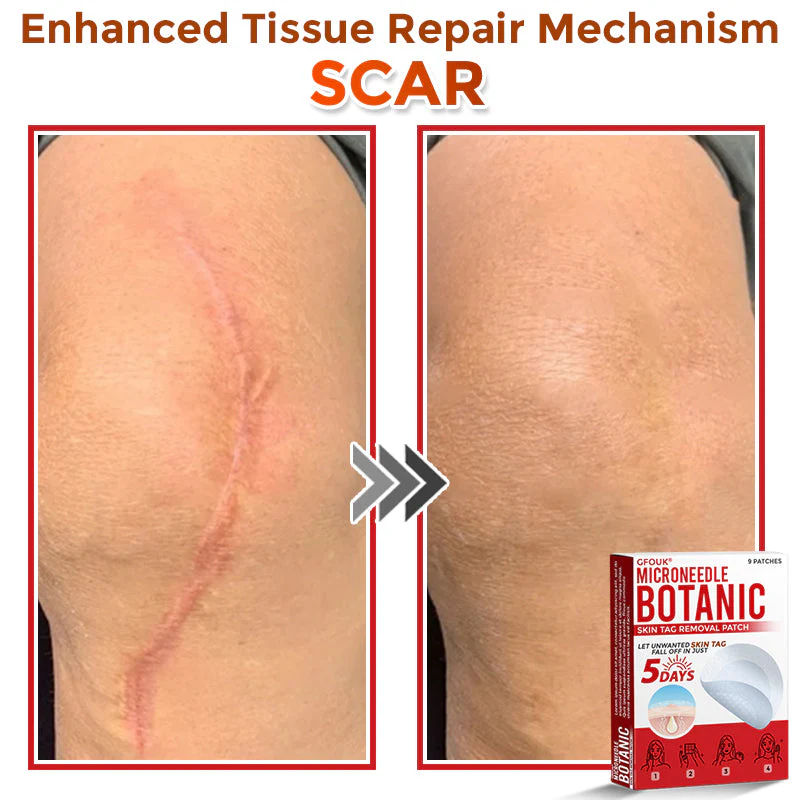 The AuraClear Skin Tag Patch - Botanic MicroNeedle Removal, Visible Results + 50% OFF - Image 10