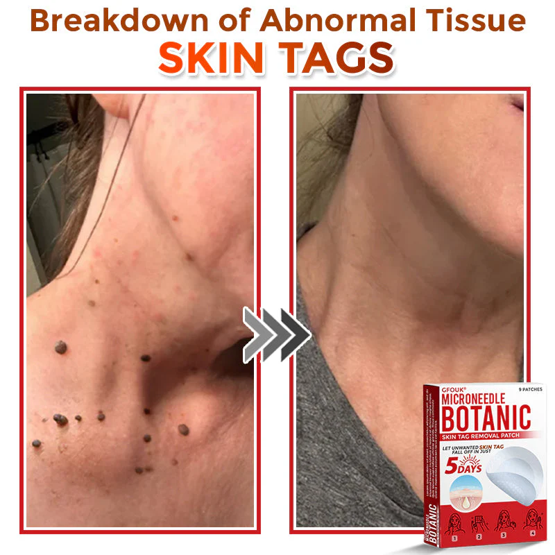 The AuraClear Skin Tag Patch - Botanic MicroNeedle Removal, Visible Results + 50% OFF - Image 4