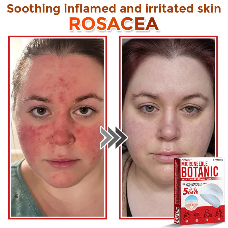 The AuraClear Skin Tag Patch - Botanic MicroNeedle Removal, Visible Results + 50% OFF - Image 5