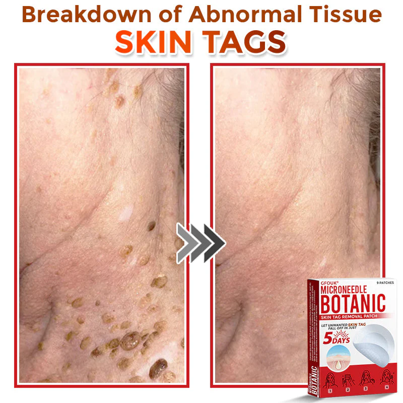 The AuraClear Skin Tag Patch - Botanic MicroNeedle Removal, Visible Results + 50% OFF - Image 6
