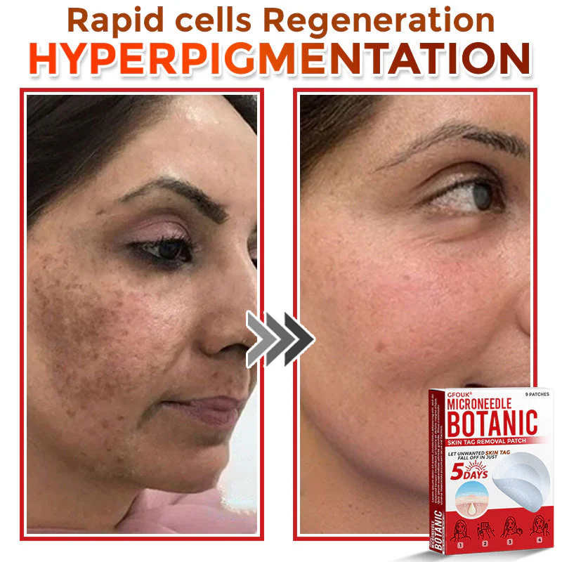 The AuraClear Skin Tag Patch - Botanic MicroNeedle Removal, Visible Results + 50% OFF - Image 7