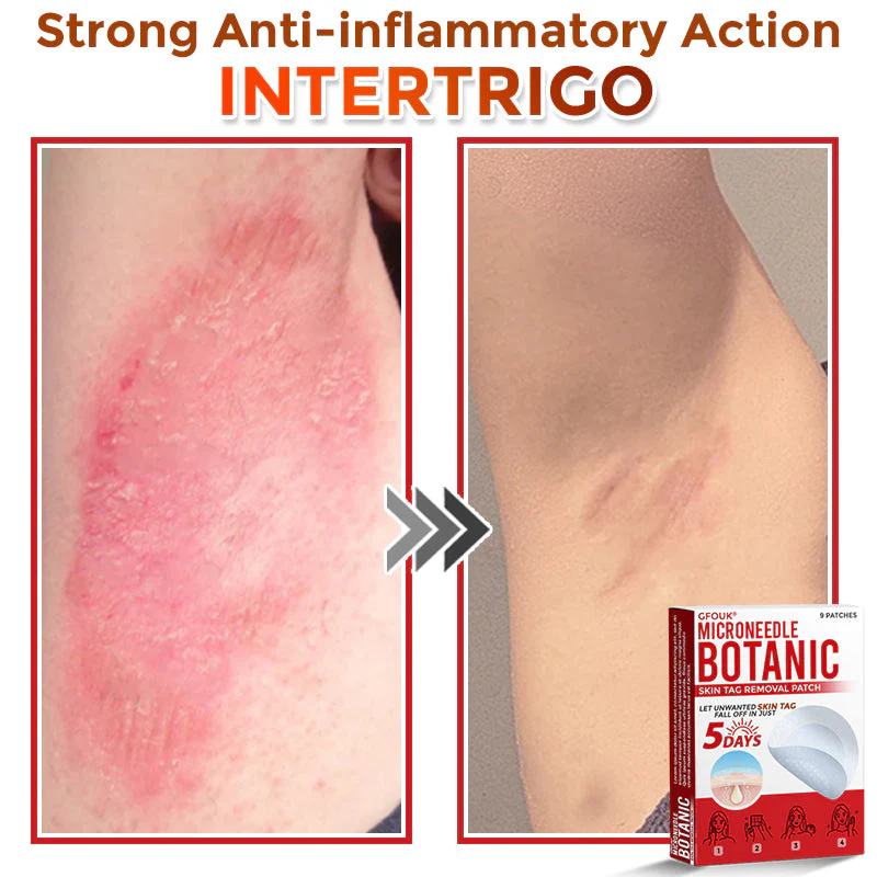 The AuraClear Skin Tag Patch - Botanic MicroNeedle Removal, Visible Results + 50% OFF - Image 8