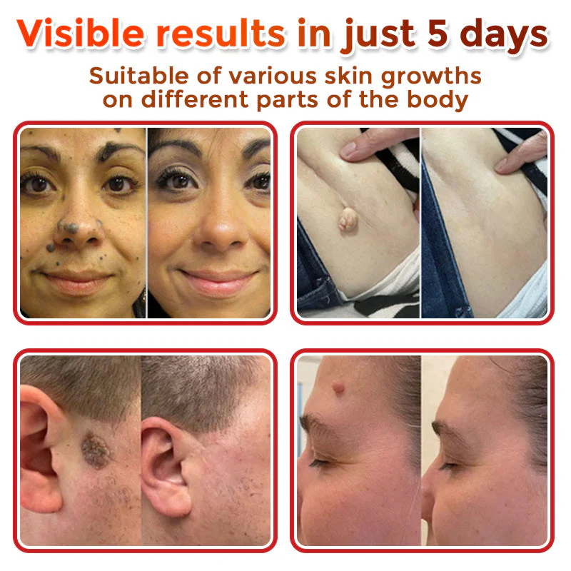 The MicroDerm Patch - Painless Skin Tag & Blemish Removal + 50% OFF - Image 5