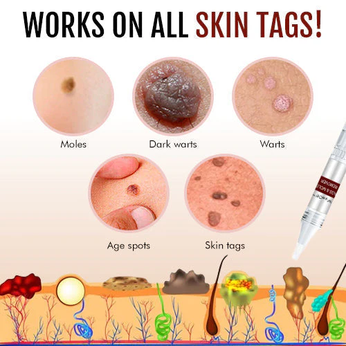 1 + 1 Free - WipeOff™ Marker & Mole Remover - Image 5